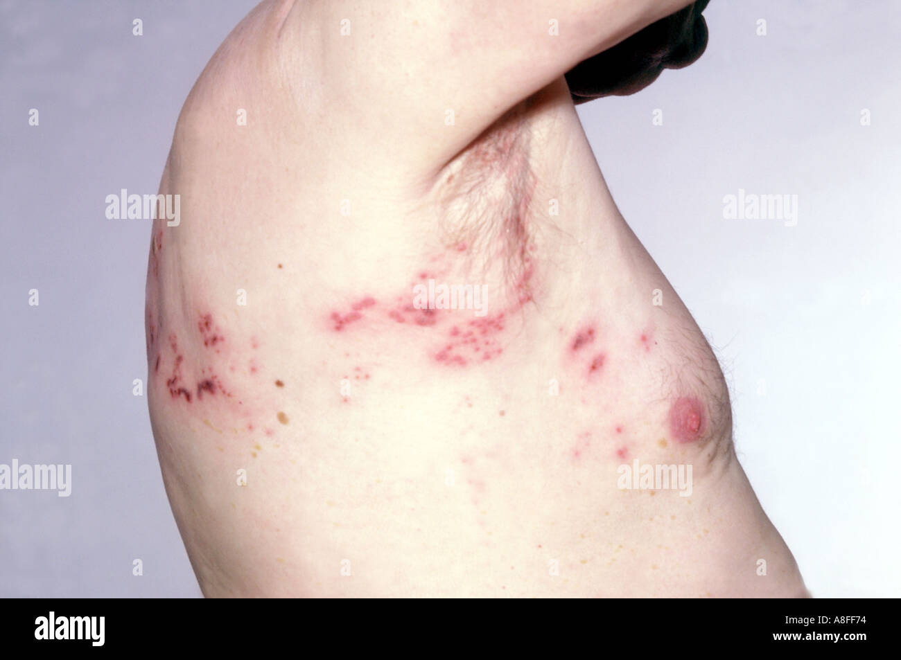 herpes zoster Stock Photo