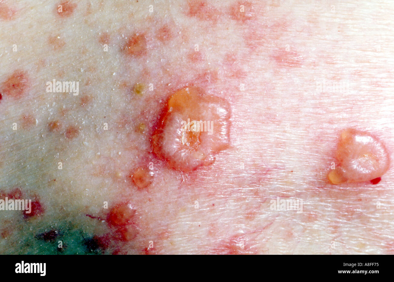 Chicken pox lesions Stock Photo