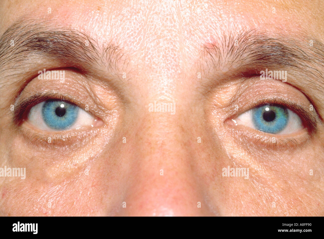 unequal pupil size after fall unequal pupil size after fall