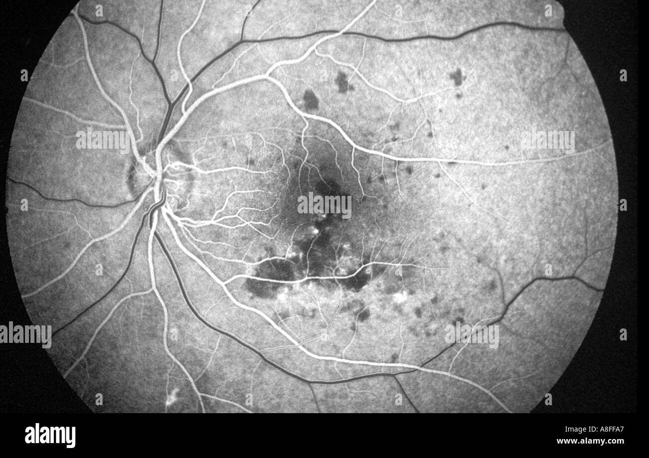 Fluorescein angiogram central serous retinopathy Stock Photo
