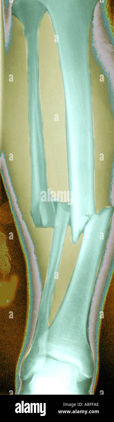 Coloured x ray of a fractured tibia and fibula Stock Photo