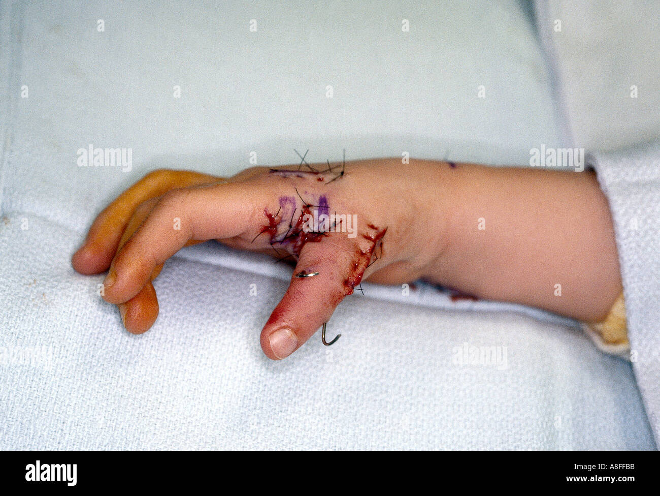 hypoplastic thumb treatment Om sn sex