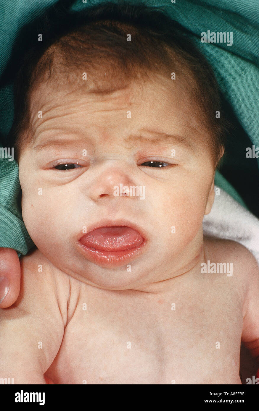 Cretinism hi-res stock photography and images - Alamy