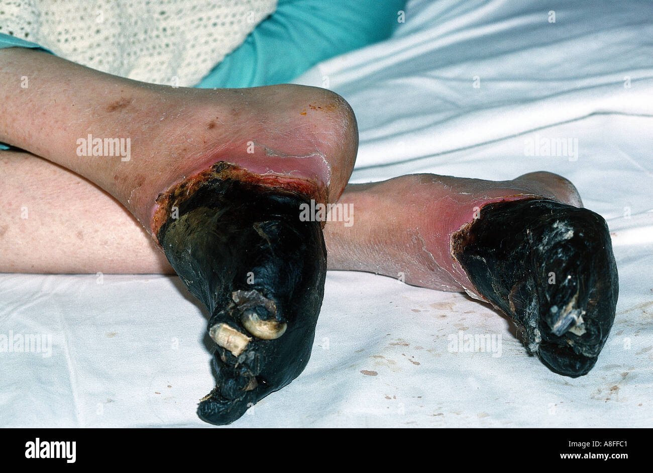 Frostbite of the feet trench foot Stock Photo