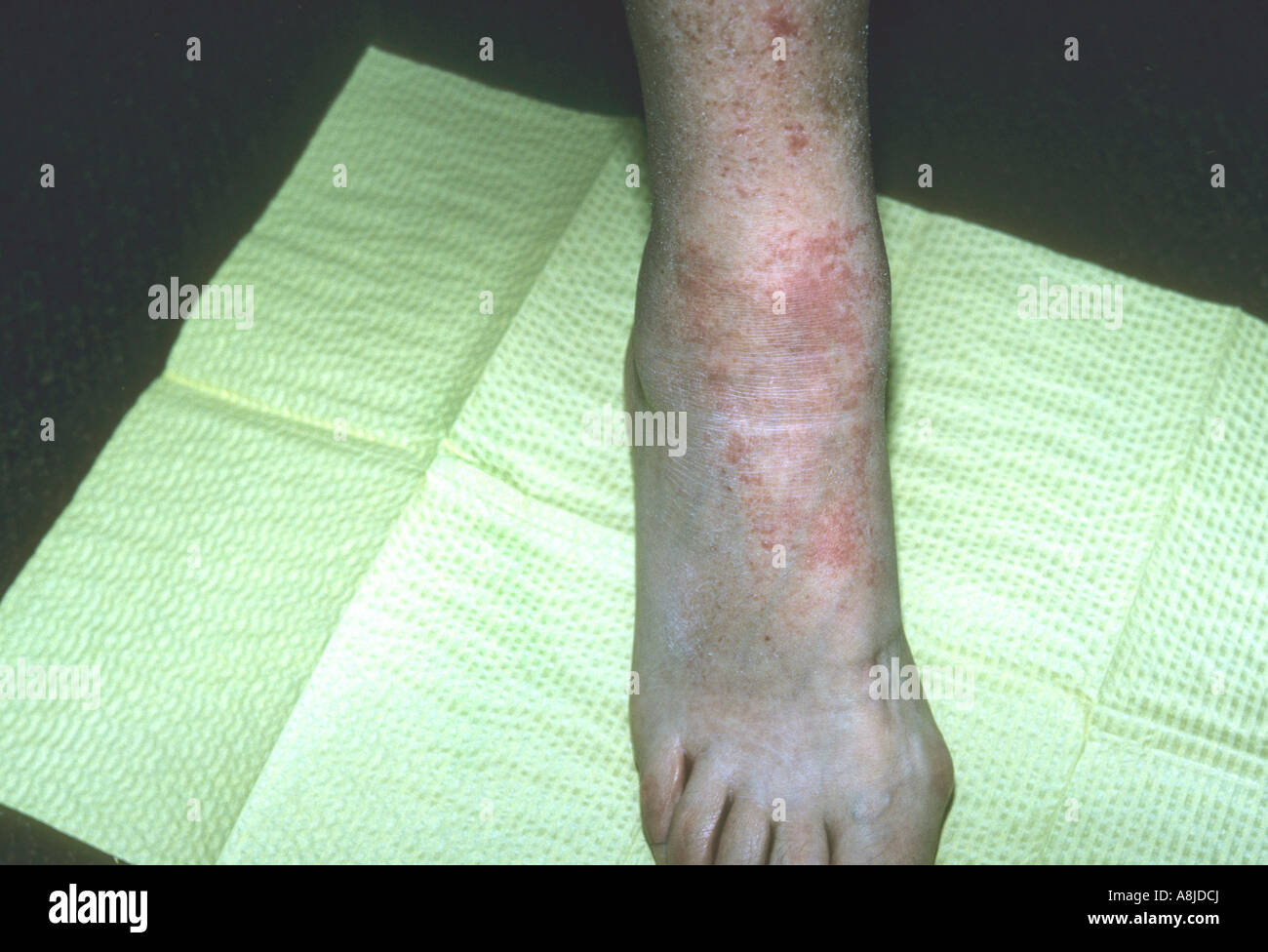 Nummular eczema on leg. Stock Photo