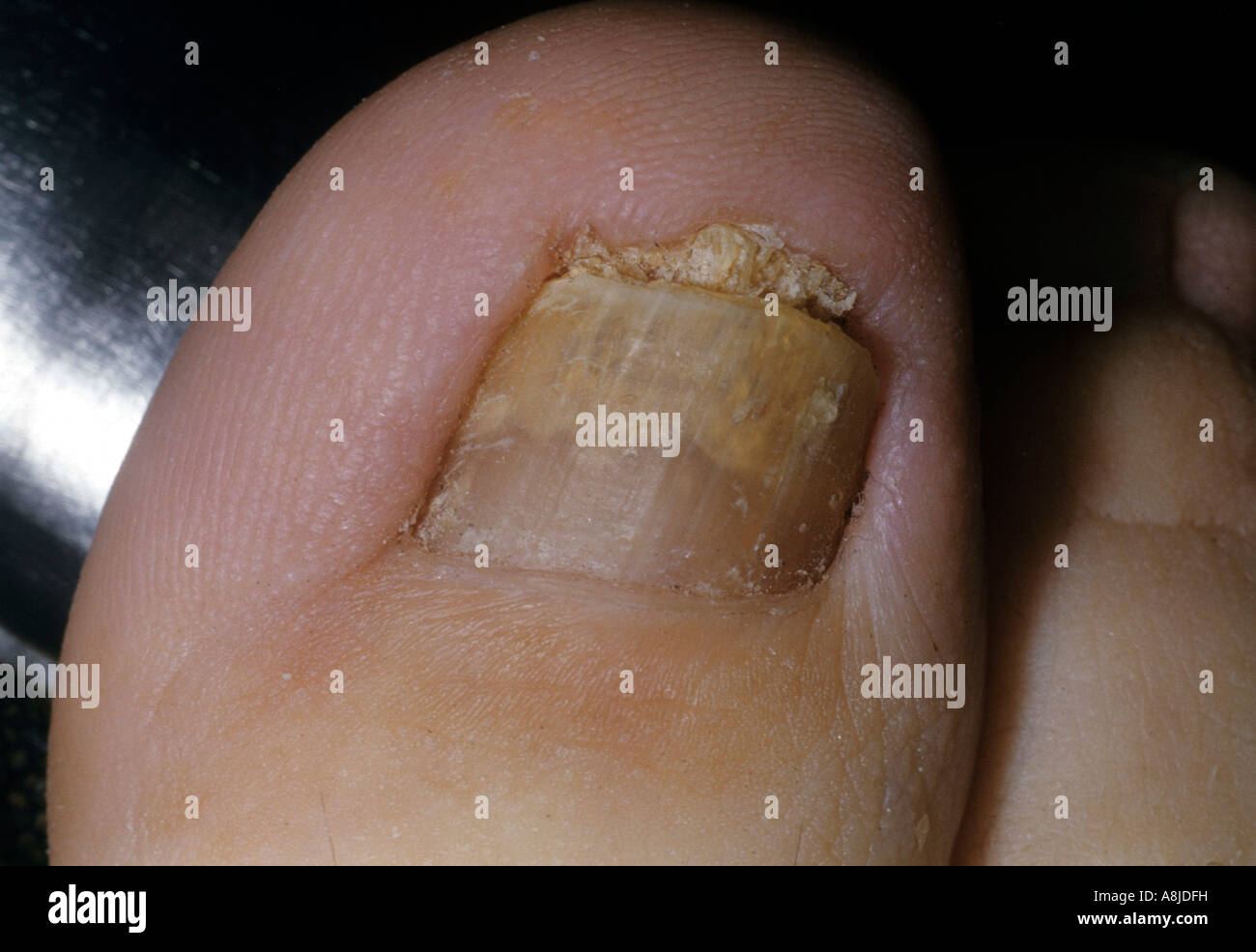 Onychomycosis or ringworm effecting patient's big toe. Stock Photo