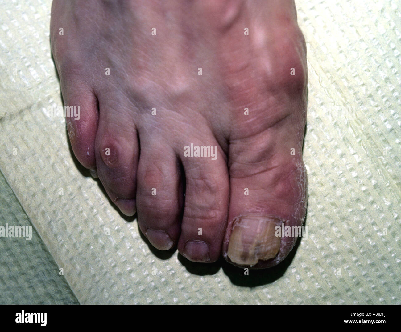 Toe fungus, onychomycosis. Also know as ringworm. Stock Photo