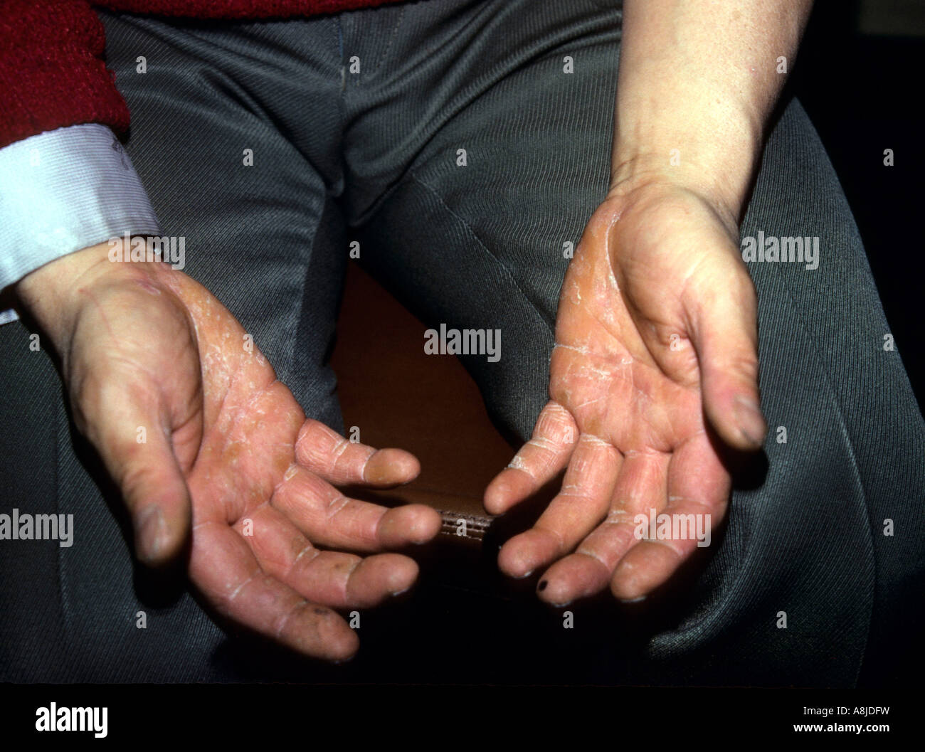 Ringworm of the hands (tinea manus) particularly the palms and the spaces between the fingers. Stock Photo