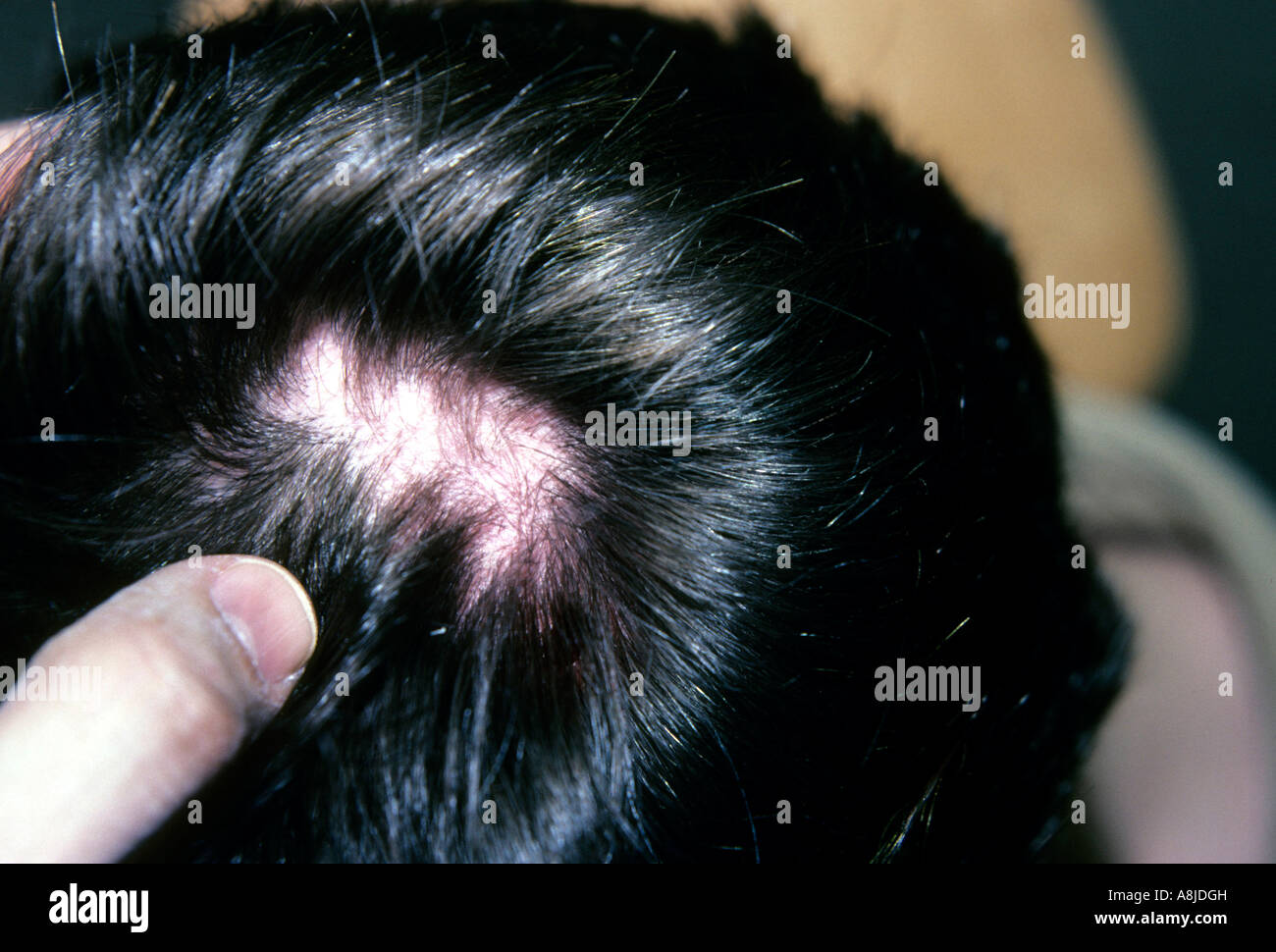 Alopecia is the premature loss of hair on the scalp, beard or pubic region Stock Photo - Alamy Alopecia is the premature loss of hair on the scalp, beard or pubic region Stock Photo - Alamy