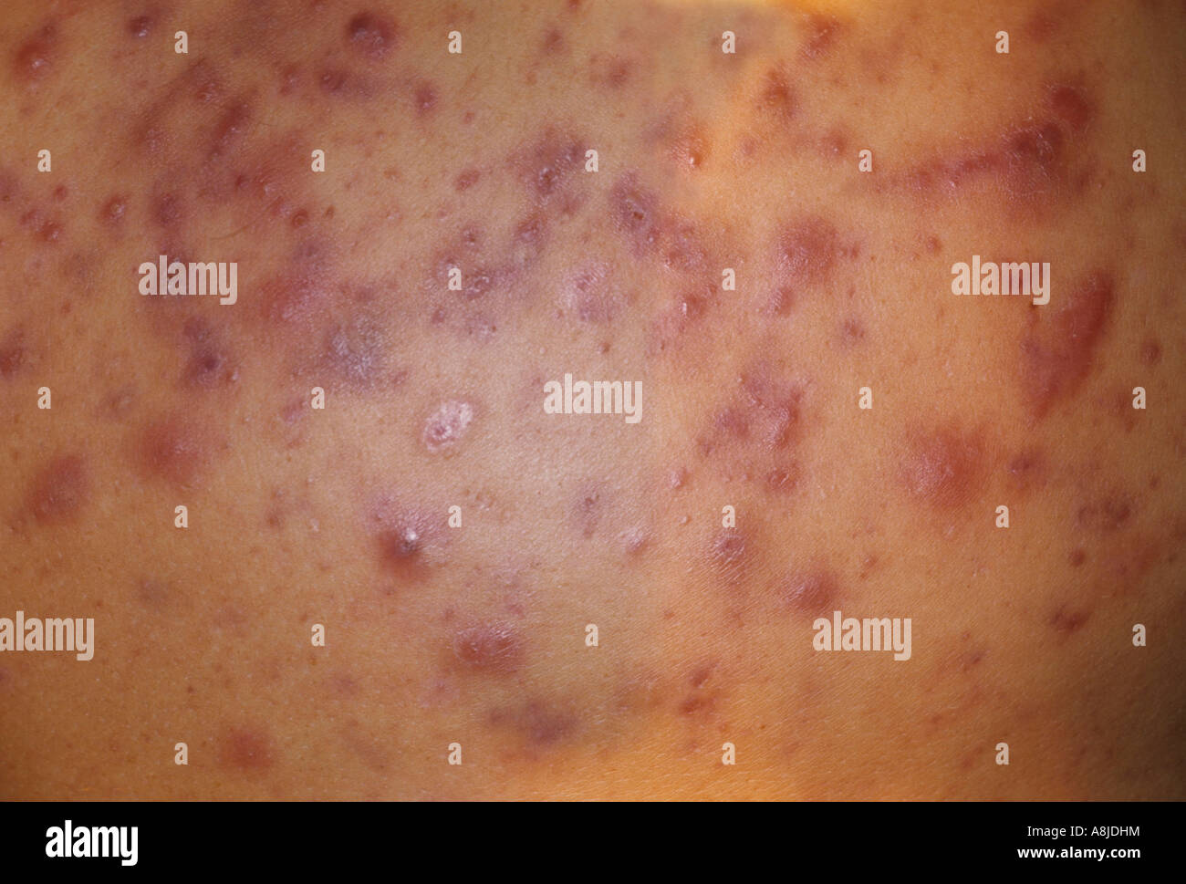 Acne Vulgaris Stock Photos & Acne Vulgaris Stock Images Alamy