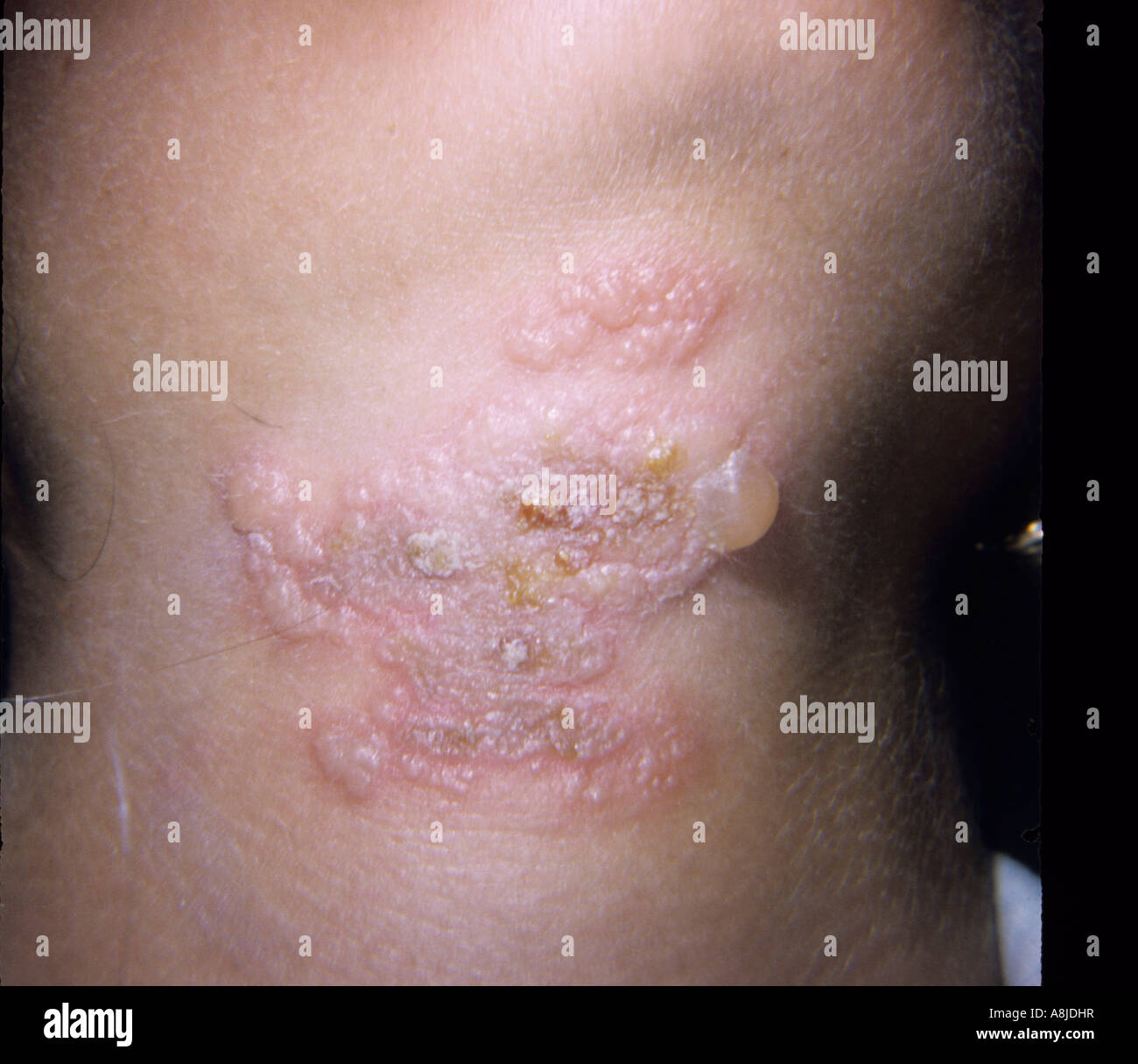 Herpes simplex rash on the patient's skin. Stock Photo