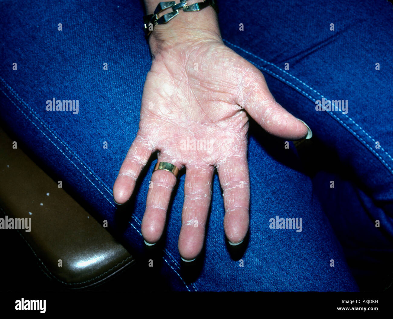 Fungus Infection Called Tinea Manus On The Hand Also Known As Ringworm