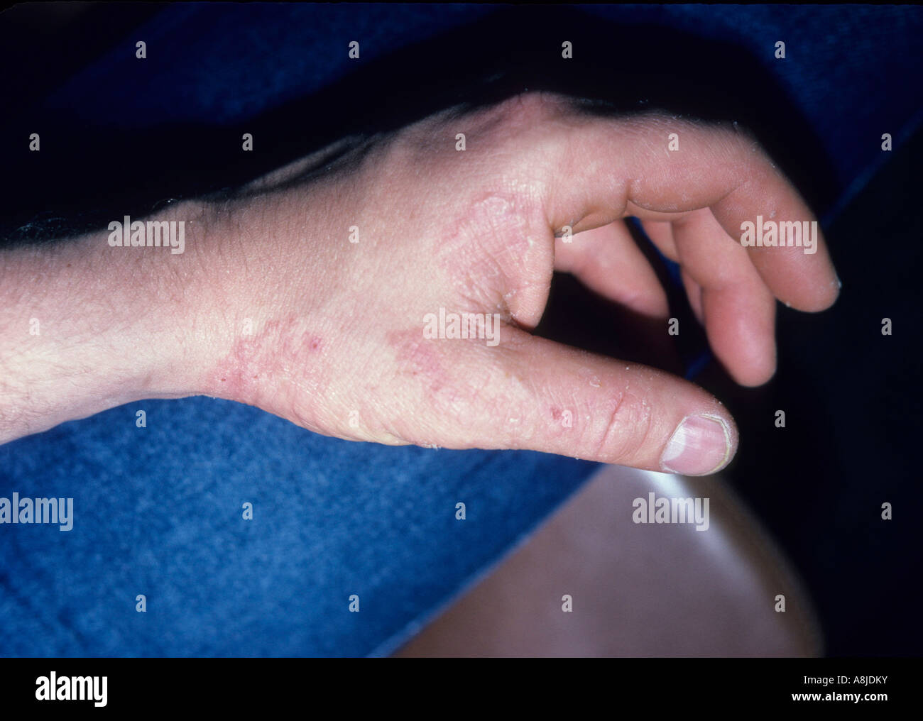 Tinea manus on hand manus hi-res stock photography and images - Alamy