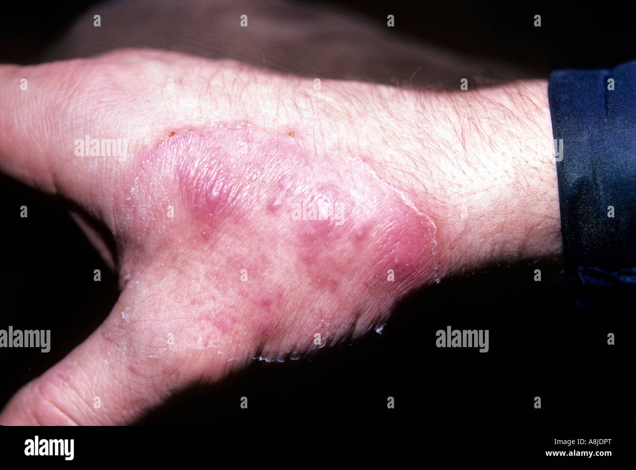 Fungal infection rash (tinea) on patient's hand. Stock Photo