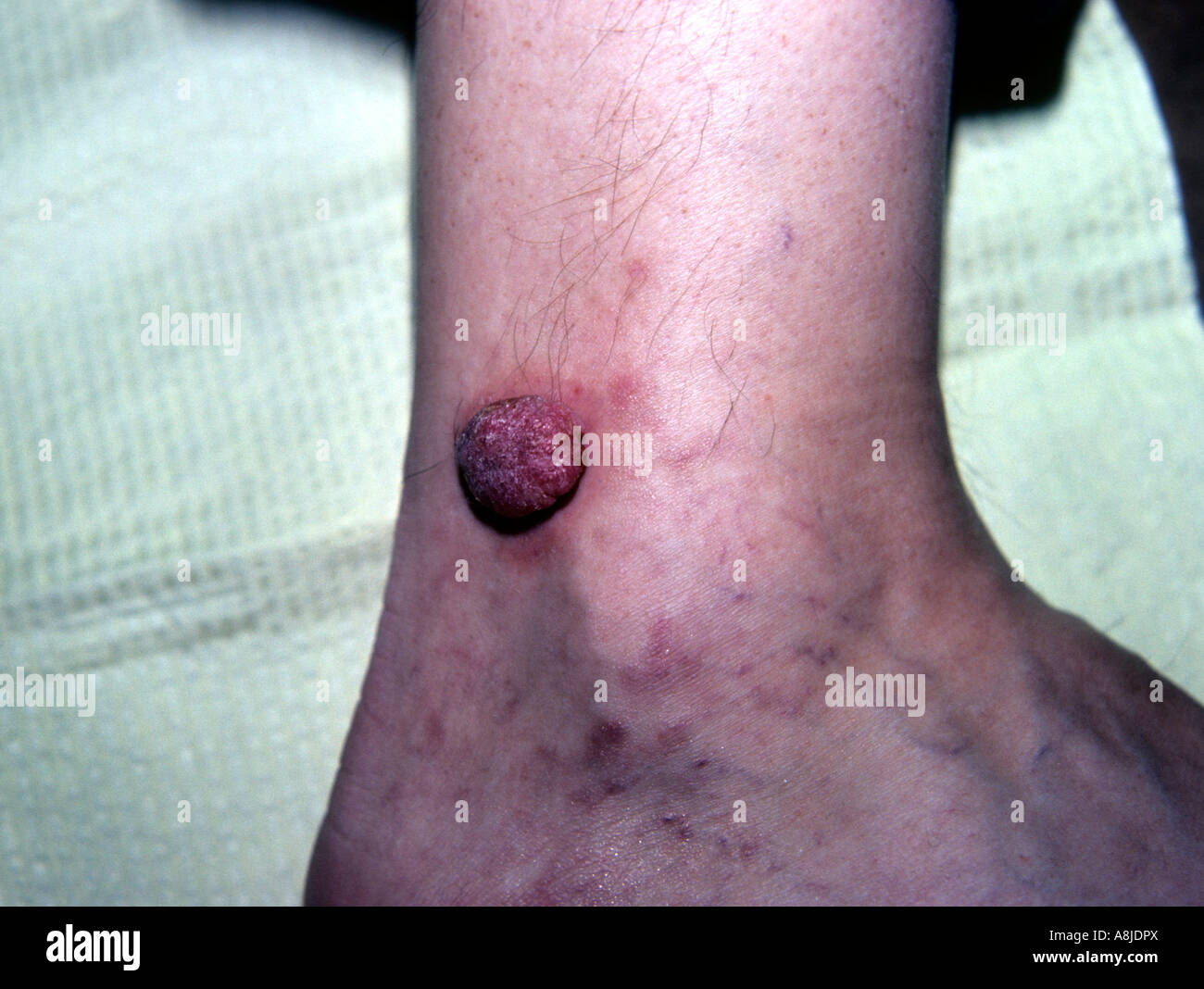 Kaposi sarcoma lesions on patient's leg, ankle area. Stock Photo