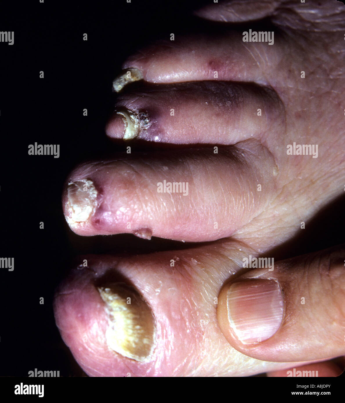 Kaposi sarcoma lesions on patient's foot. Stock Photo