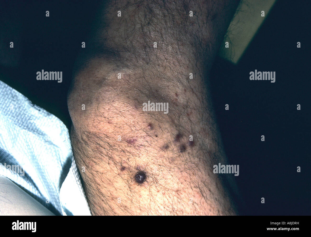 Close up photo of Kaposi sarcoma lesion on patient's foot/heal.This image may not be  model released due to non-recognizable pe Stock Photo