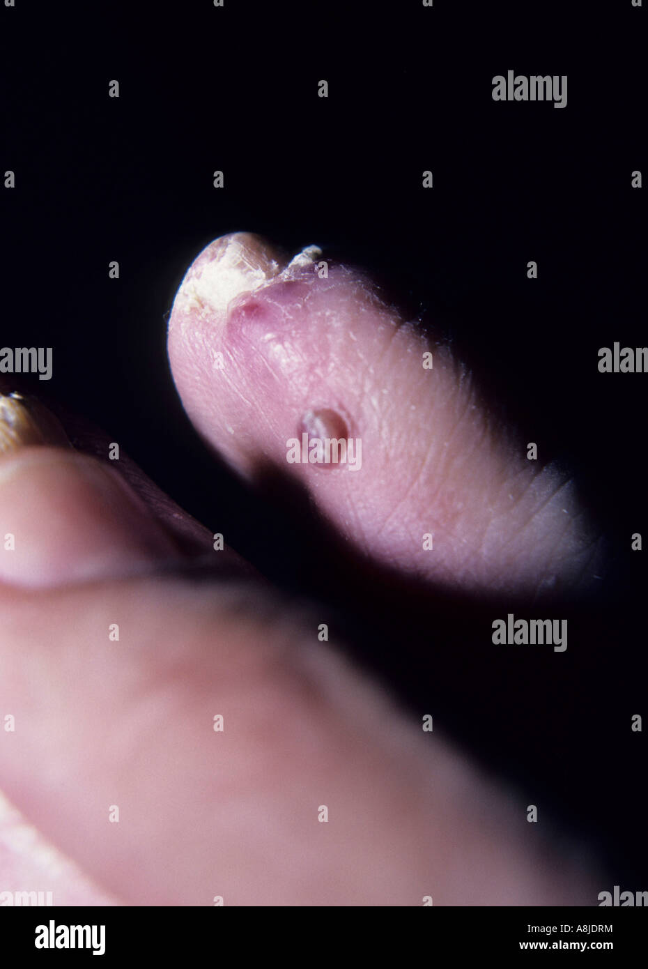 Close up photo of Kaposi sarcoma lesion on patient's finger. Stock Photo