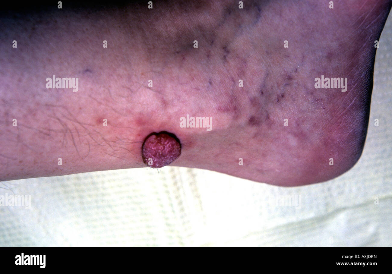 Close up photo of Kaposi sarcoma lesion on patient's foot. Stock Photo