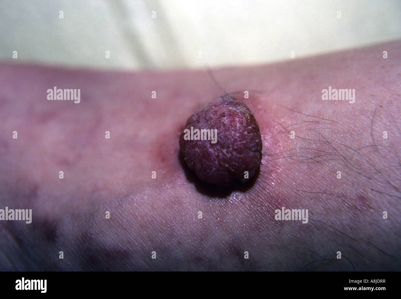 Close up photo of Kaposi sarcoma lesion on patient's leg. Stock Photo
