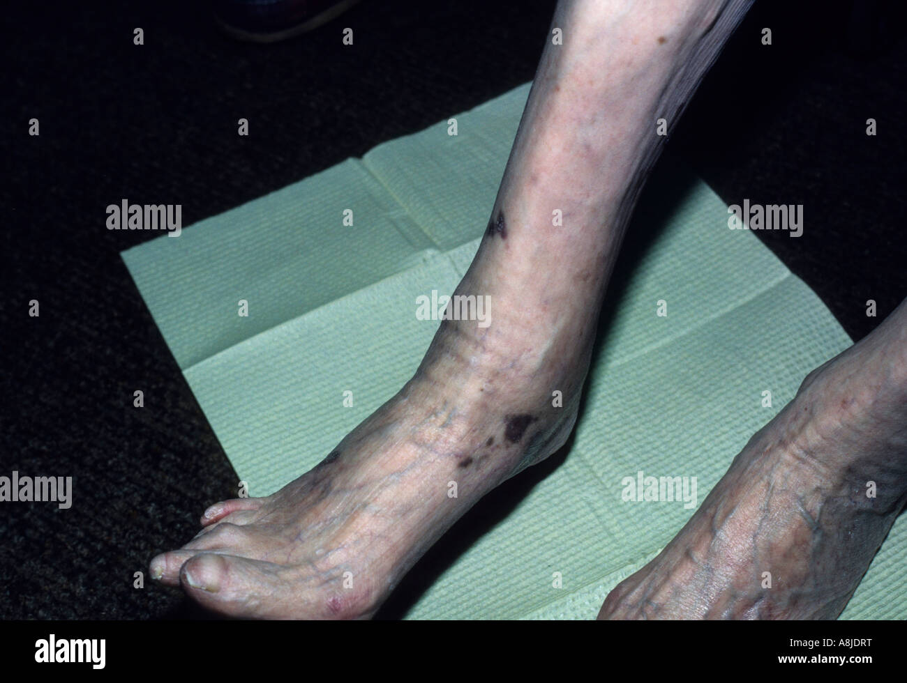 Kaposi sarcoma lesions on patient's leg. Stock Photo