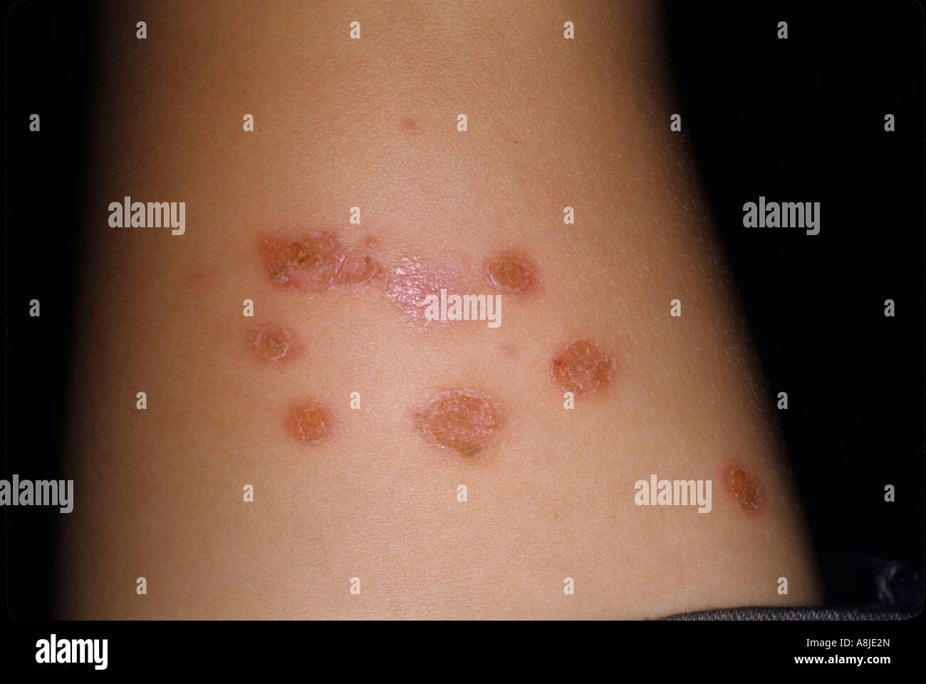 Staph aureus hires stock photography and images Alamy