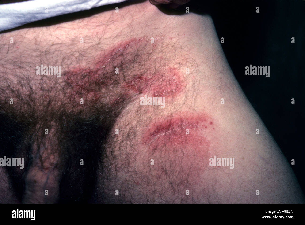 male patient with jock itch also known as ring worm in the groin area A8JE3N