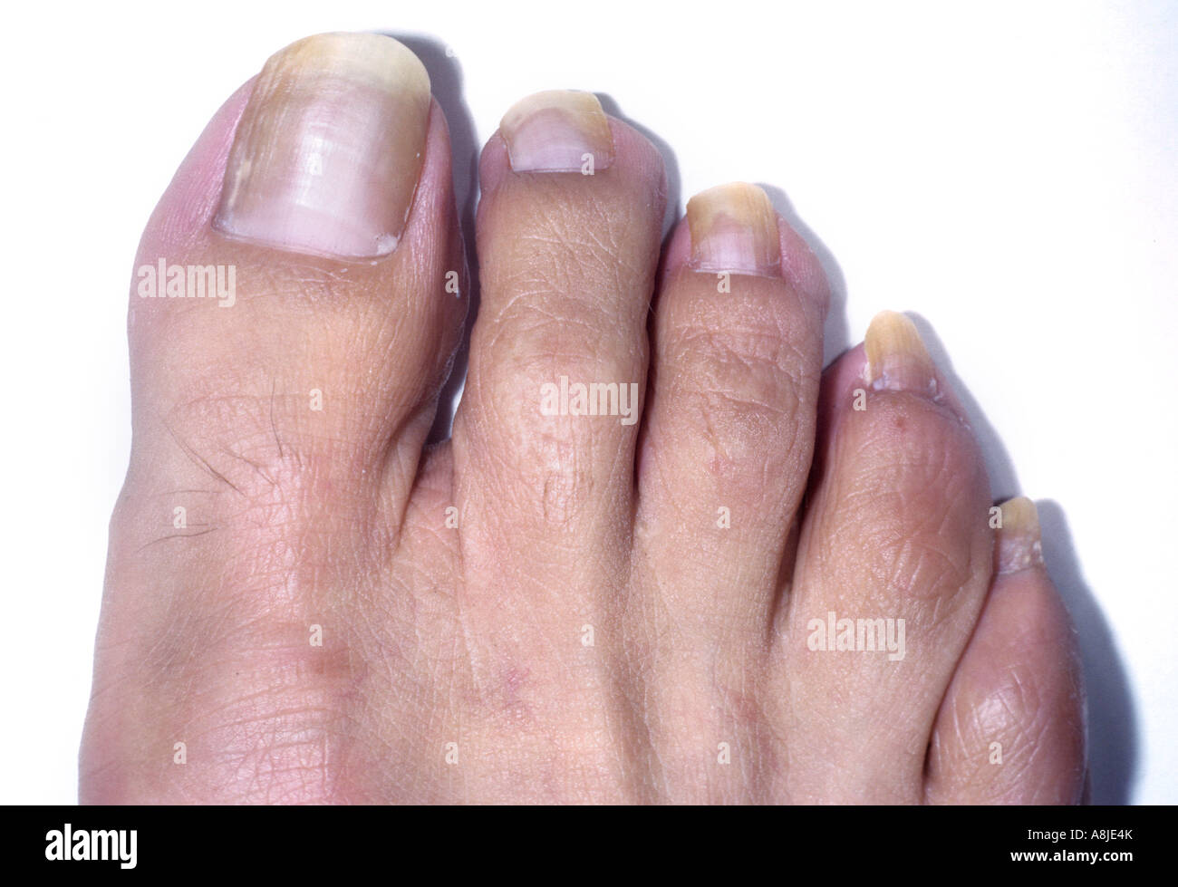 Tinea unguium effecting the toe nails. Diagnosis: Onychomycosis Stock Photo  - Alamy