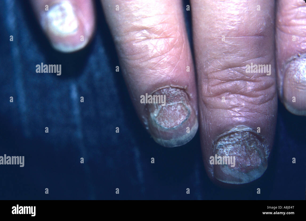 Tinea manus fingers and Tinea unguium of the nails. Stock Photo