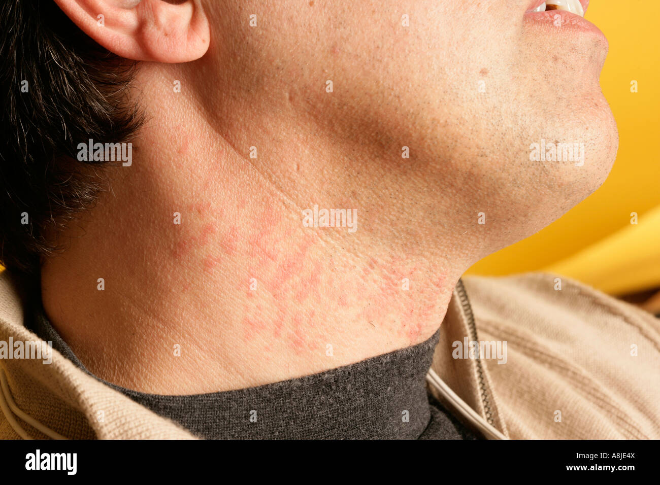 Tinea barbae hi-res stock photography and images - Alamy