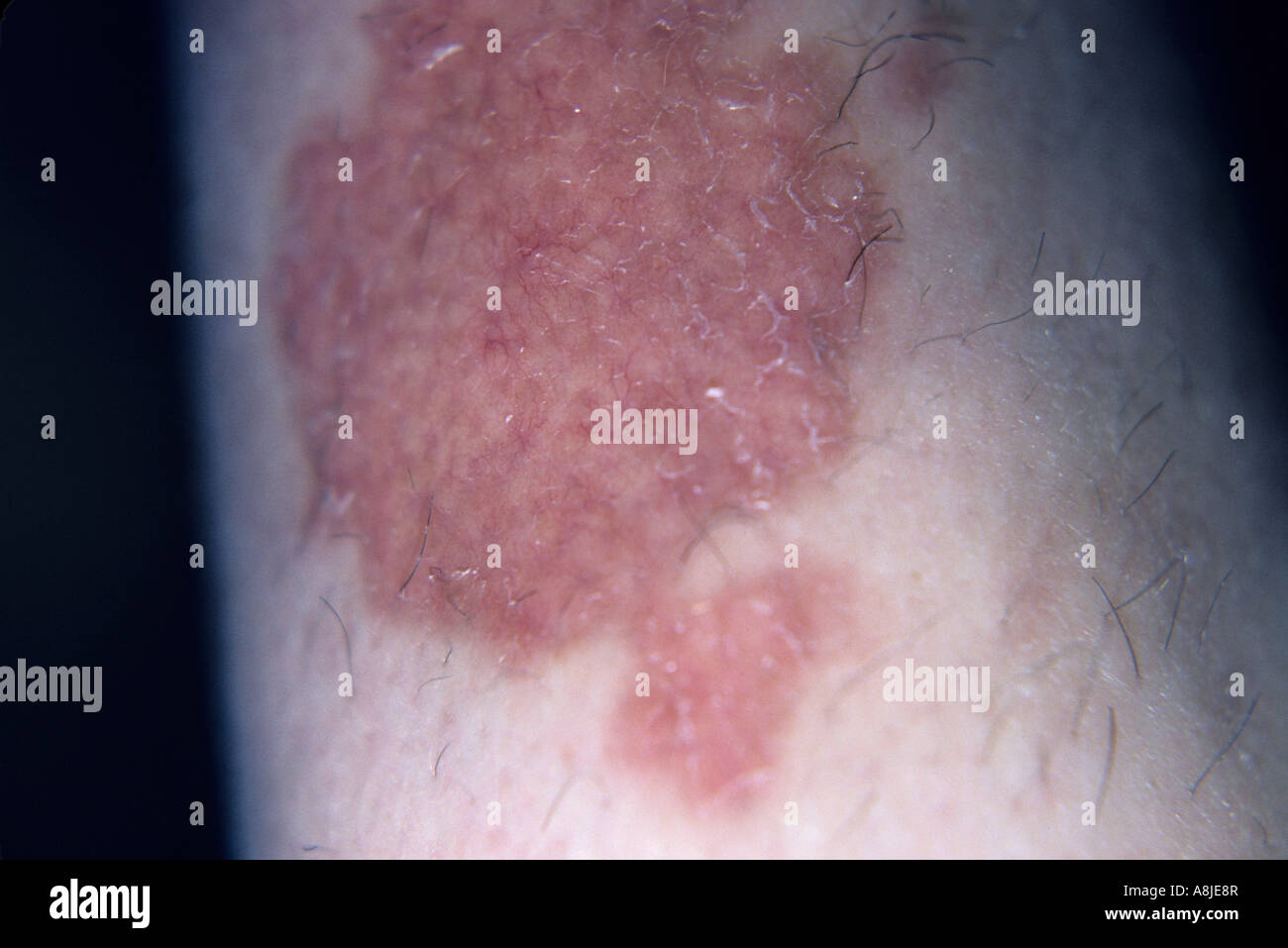Diabeticorum (NDL) is a rash which usually occurs on the legs Stock