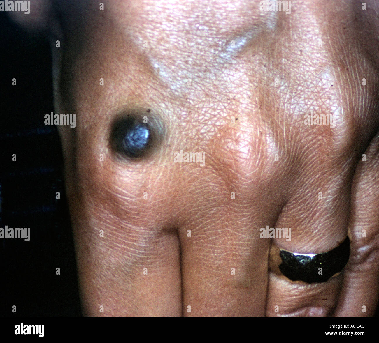 Benign blue nevus on hand near the knuckles Stock Photo