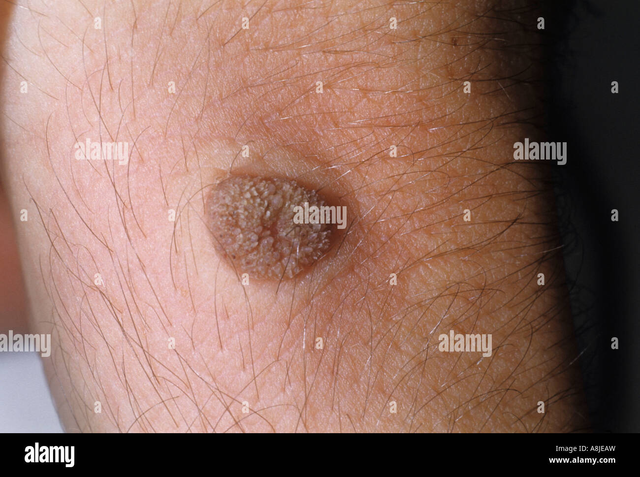 Wart on wrist caused by the HPV (Human Papilloma Virus Stock Photo
