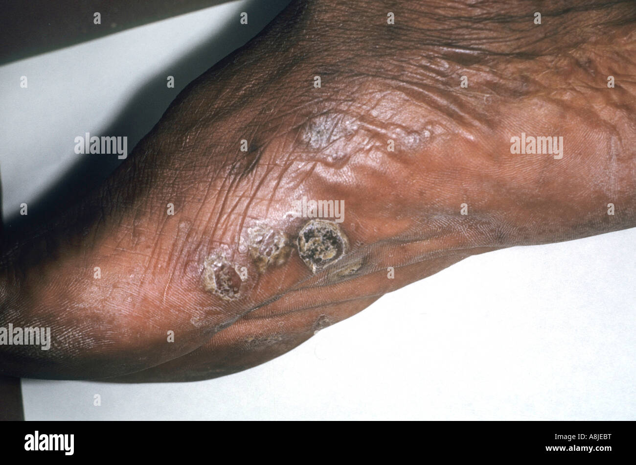 Dyshidrosis is a skin condition of the palms and soles. The alternative name is Pompholyx. Stock Photo