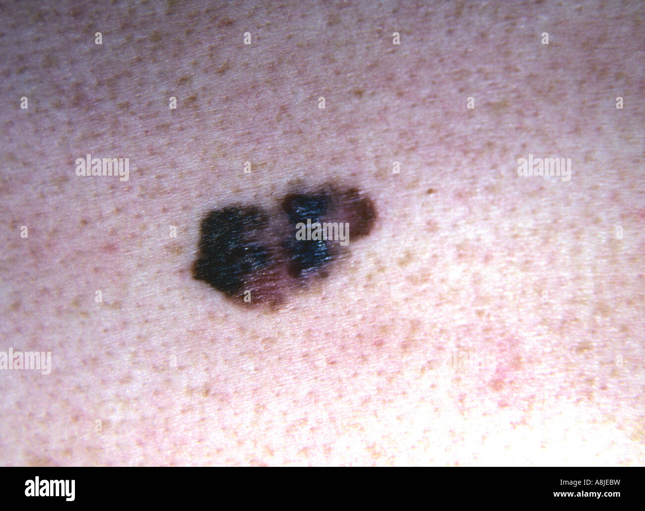 Nodular malignant melanoma. A form of skin cancer Stock Photo - Alamy