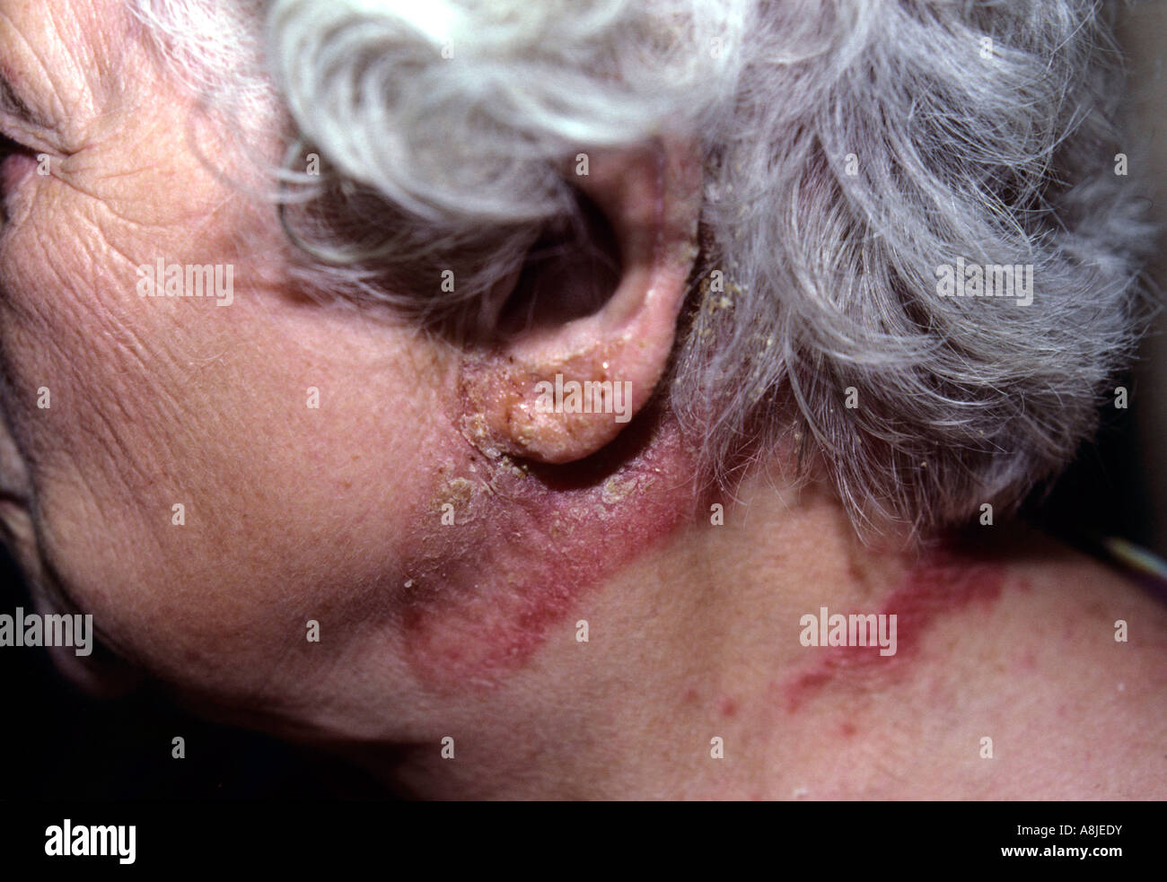 Allergy to clothing. Rash appears on patient's neck. Stock Photo