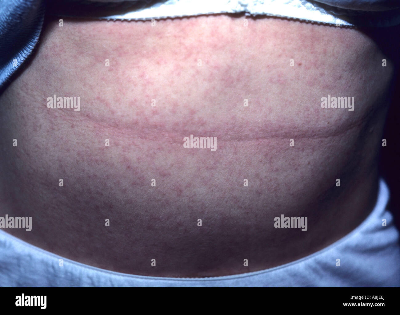 Allergic contact eczema (dermatitis) rash on the patient's abdomen. Stock Photo