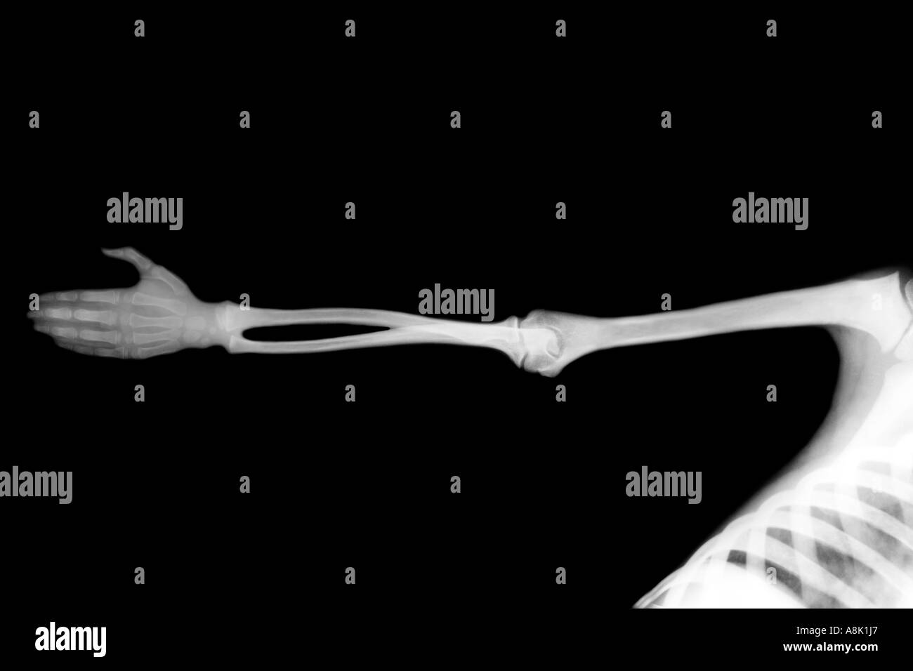 outstretched arm x-ray Stock Photo