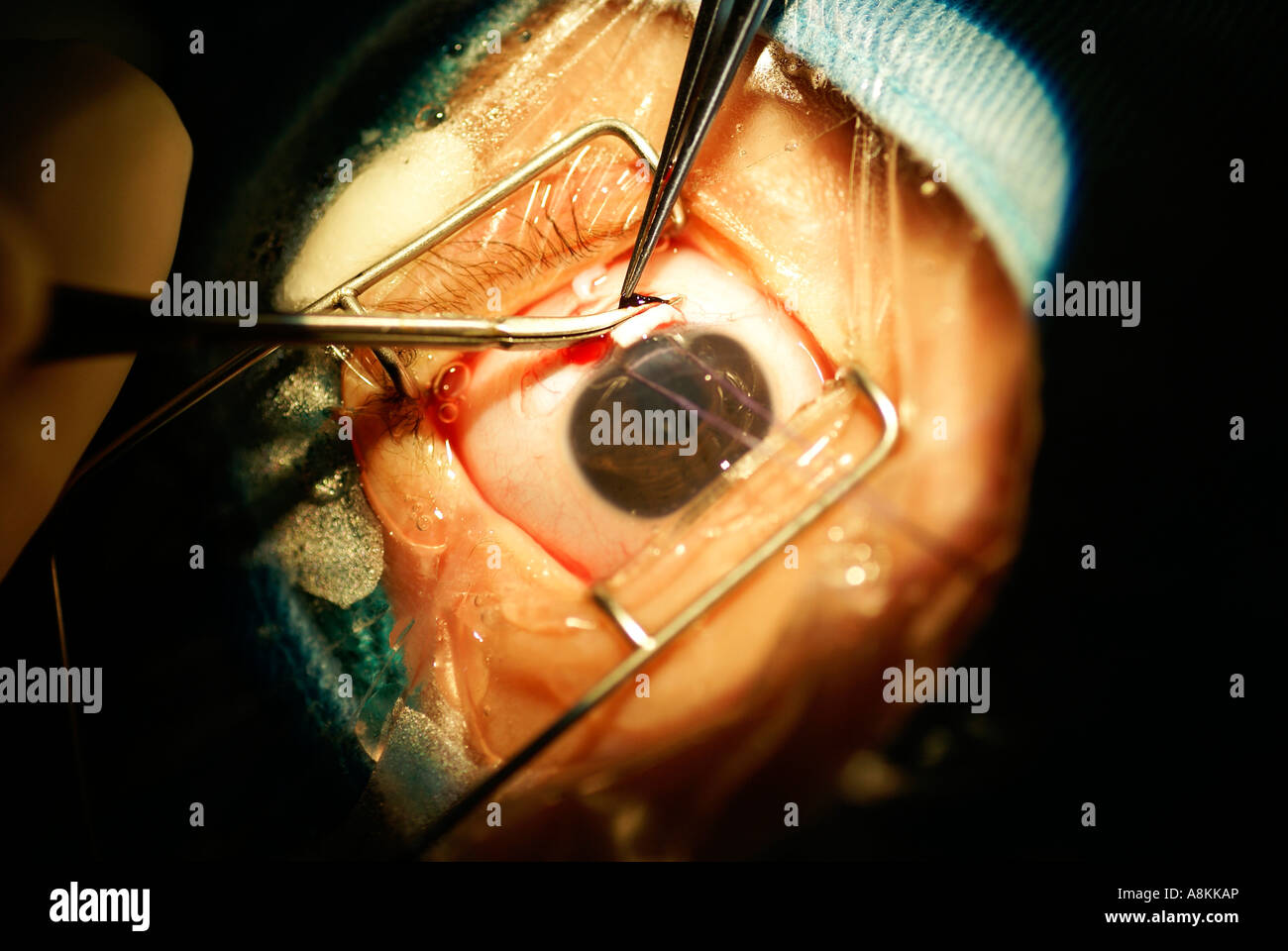 Glaucoma surgery Stock Photo