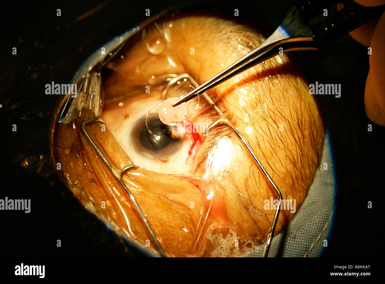 Cataract surgery: Implantation of an artificial intraocular lens Stock Photo