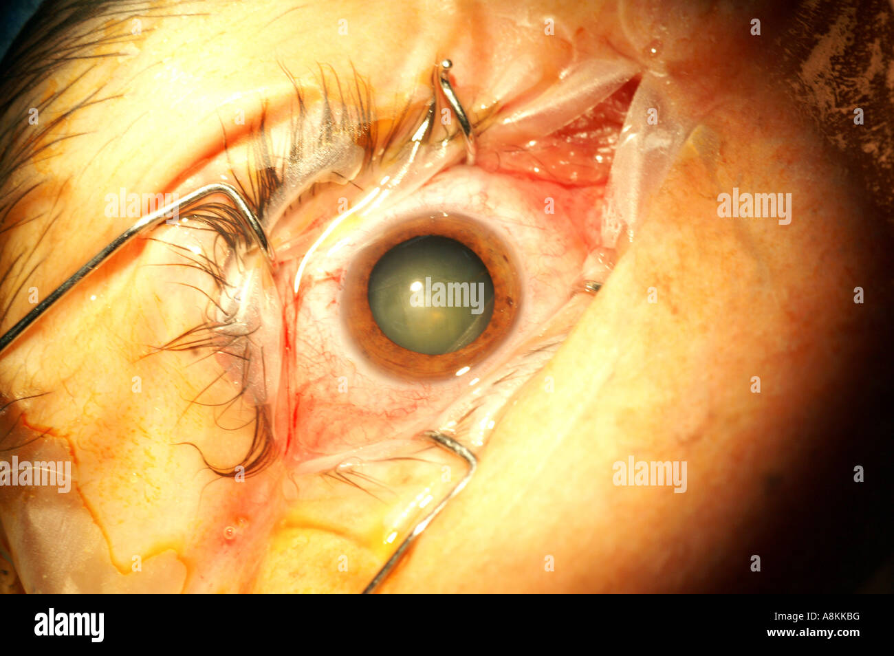 Cataract surgery with the phacoemulsification method: cataract before the surgery Stock Photo