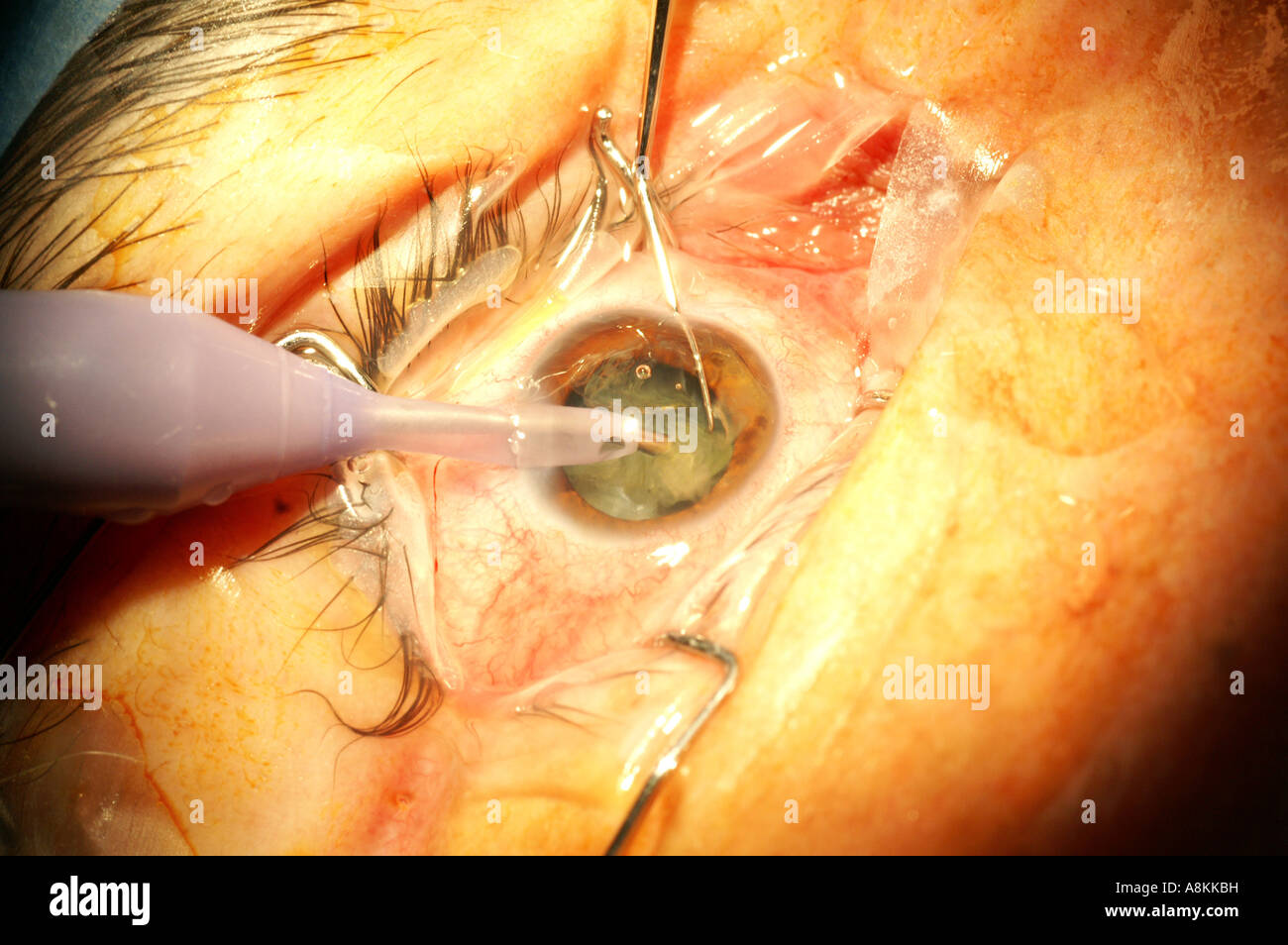Cataract surgery with the phacoemulsification method: the cataract is beeing destroyed with ultrasound and sucked off Stock Photo
