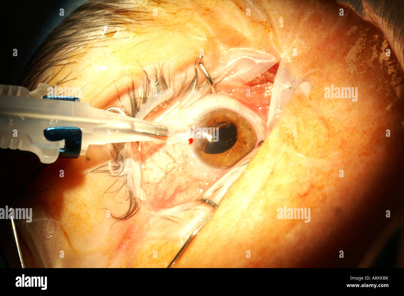 Cataract surgery with the phacoemulsification method: after taking out the cataract a foldable intraocular lens is beeing injec Stock Photo