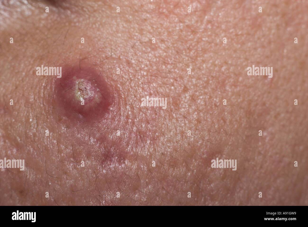 Large pimple hi-res stock photography and images - Alamy
