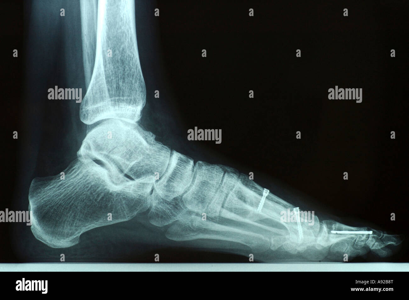 Xray photo of a left foot after bunion surgery with screws and other