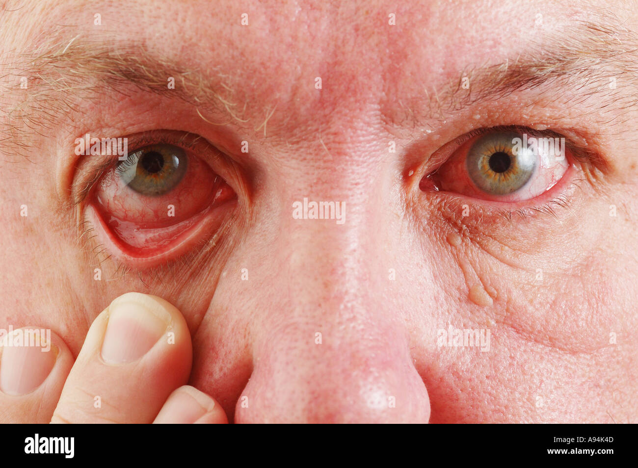 My bloodshot eyes after leaving contact lenses in for to long dsca 3225 Stock Photo Alamy