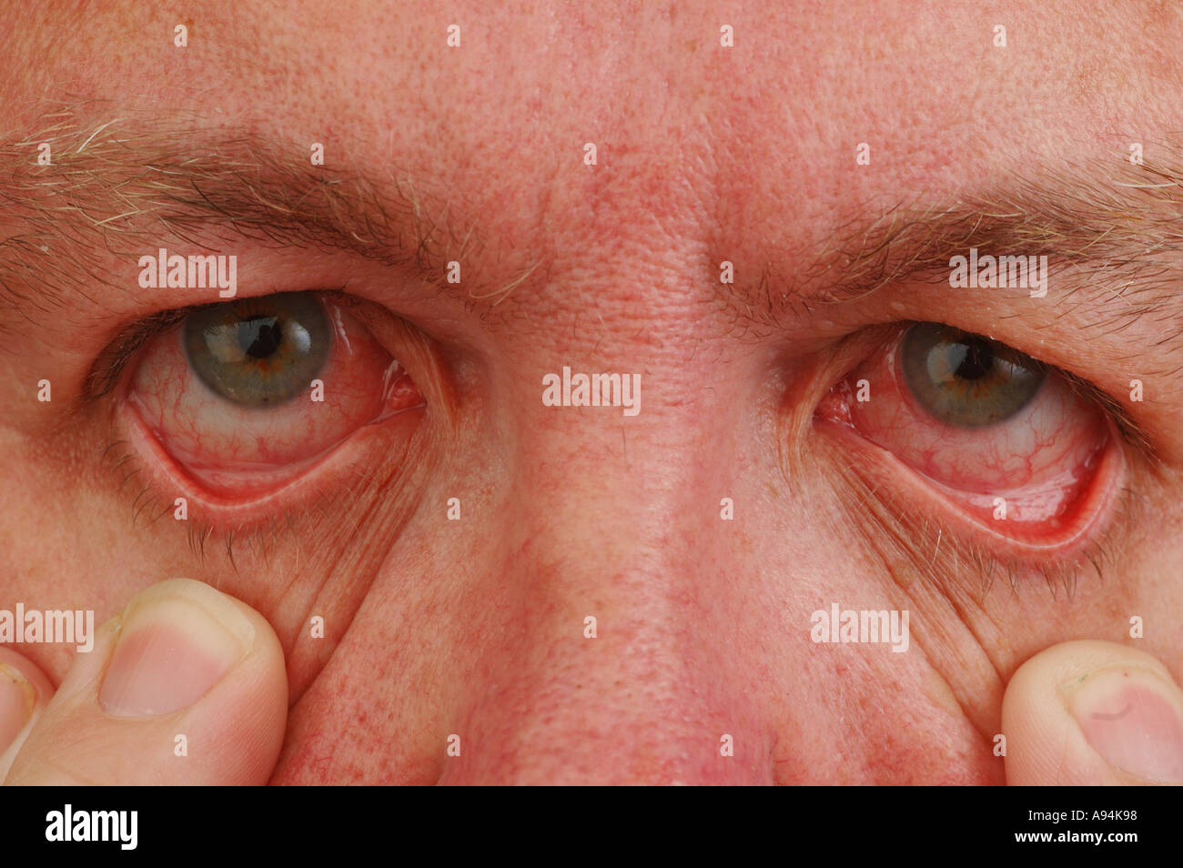 My bloodshot eyes after leaving contact lenses in for to long dsca 3260 Stock Photo