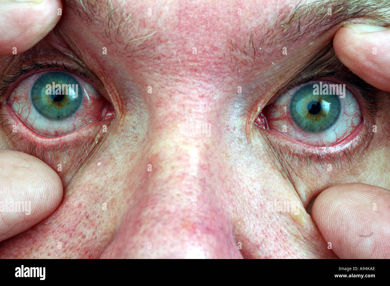 Bloodshot eyes hires stock photography and images Alamy