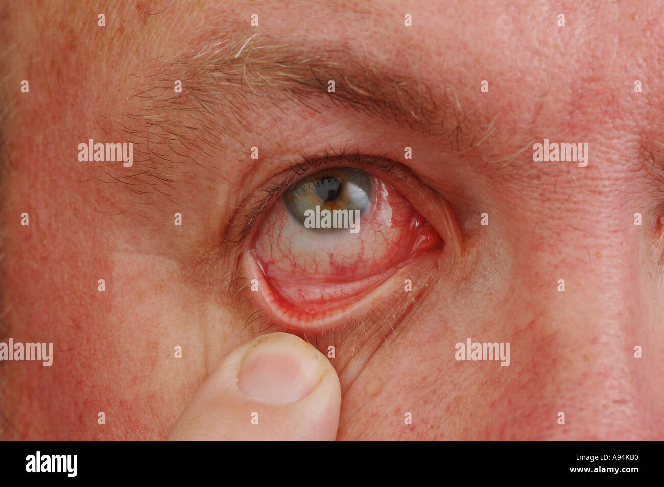 Sleep Less Red Eye Sleep Deprived Eyes Red