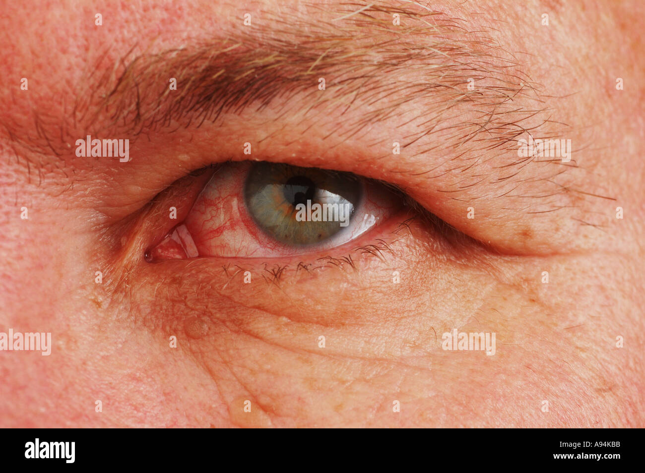 Blood in sclera hires stock photography and images Alamy